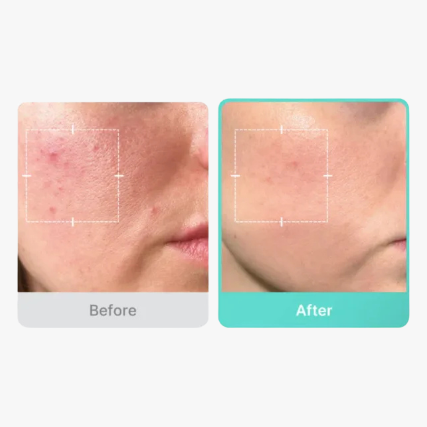 Azelaic Acid 16 BB Calming – Serum Antiacne Calmante 30ml
