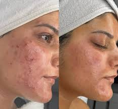 🌟 Peeling ácido Azelaico 20% (Acné)