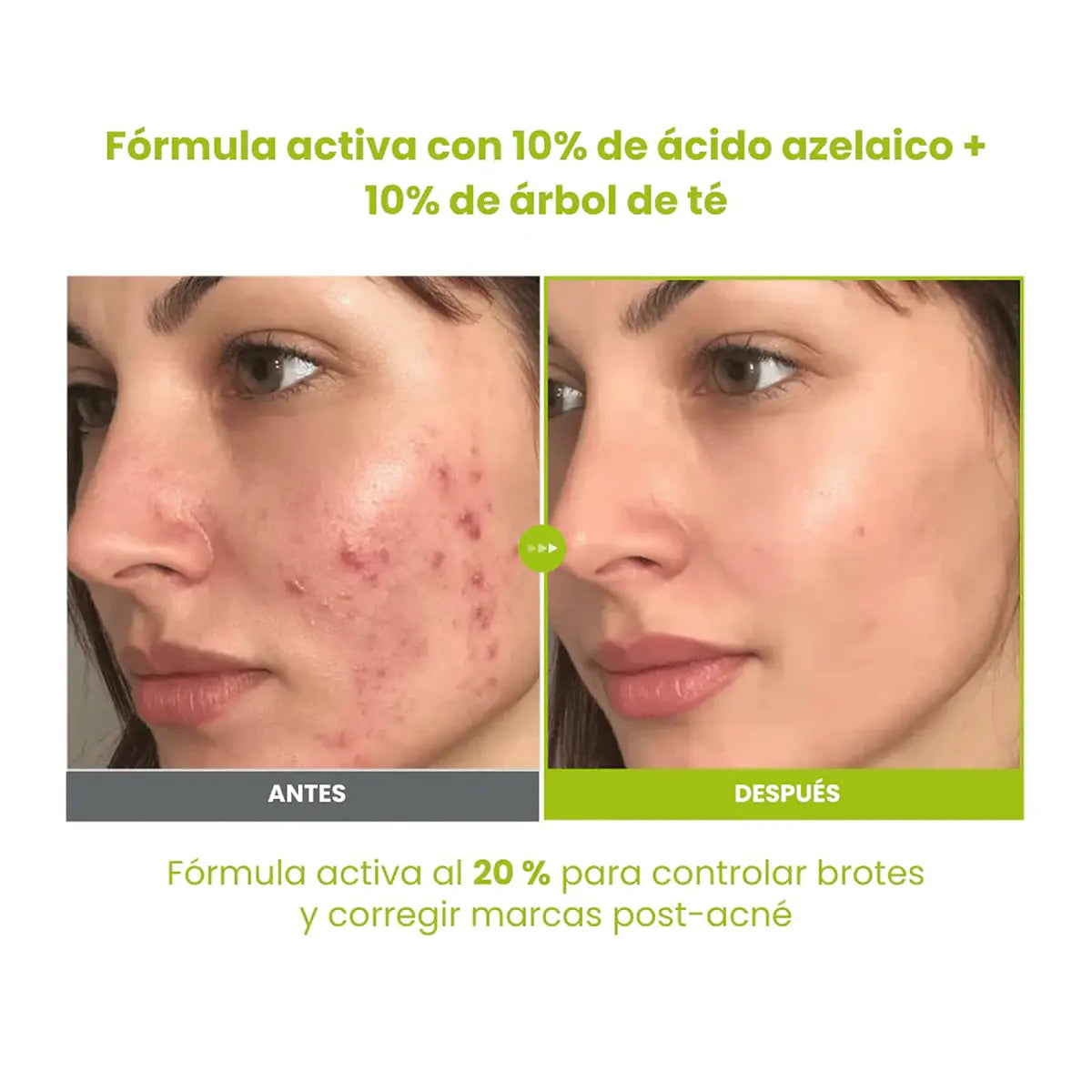 Azelaic Acid 10 Kojic Tea Tree Serum 30 ml