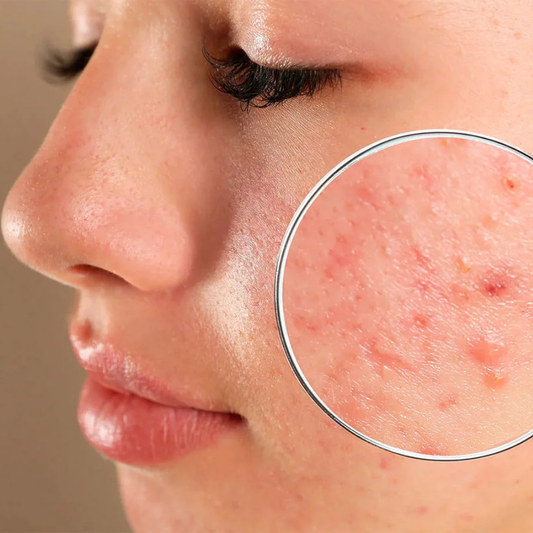 🧪 Elixir Pen Balance Piel Mixta / Grasa / Acné (NUEVO!)