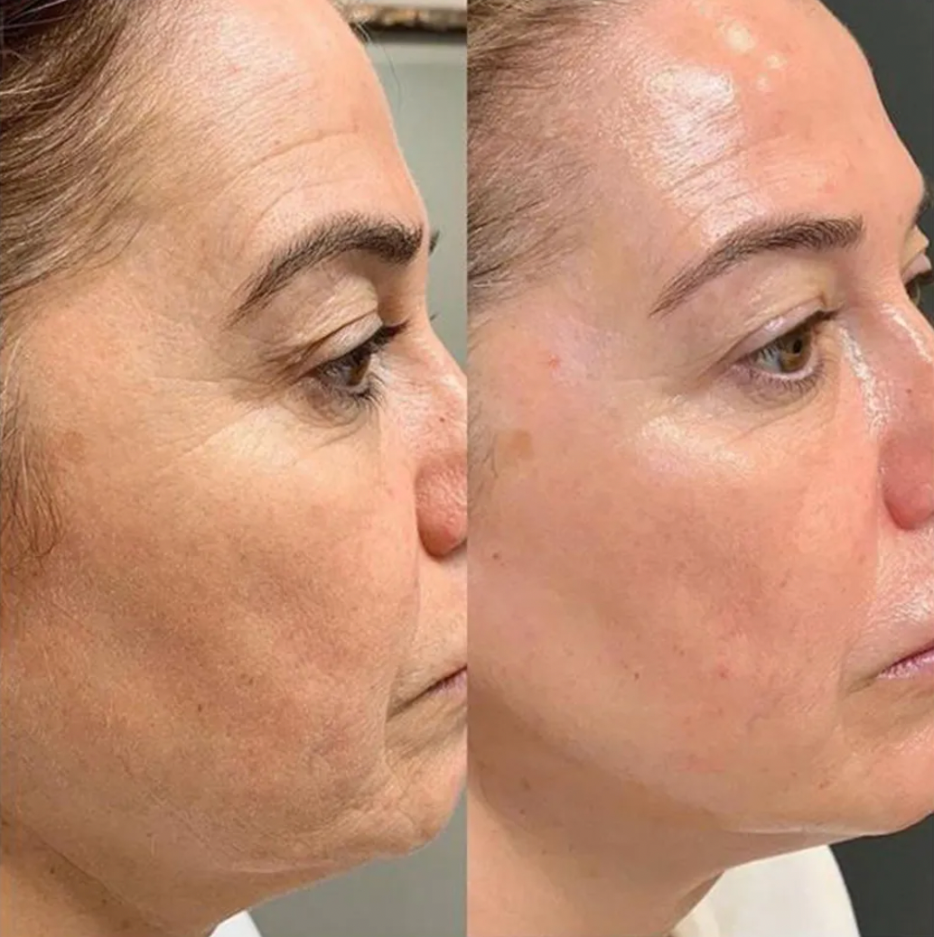 💥 Peeling Antiage Ácido Pirúvico 40%