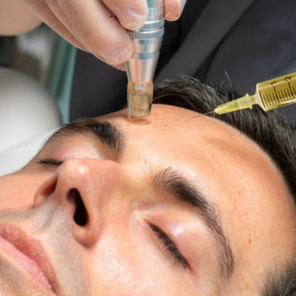 🔬  Mesoterapia Microneedling Expert Cocktail Therapy