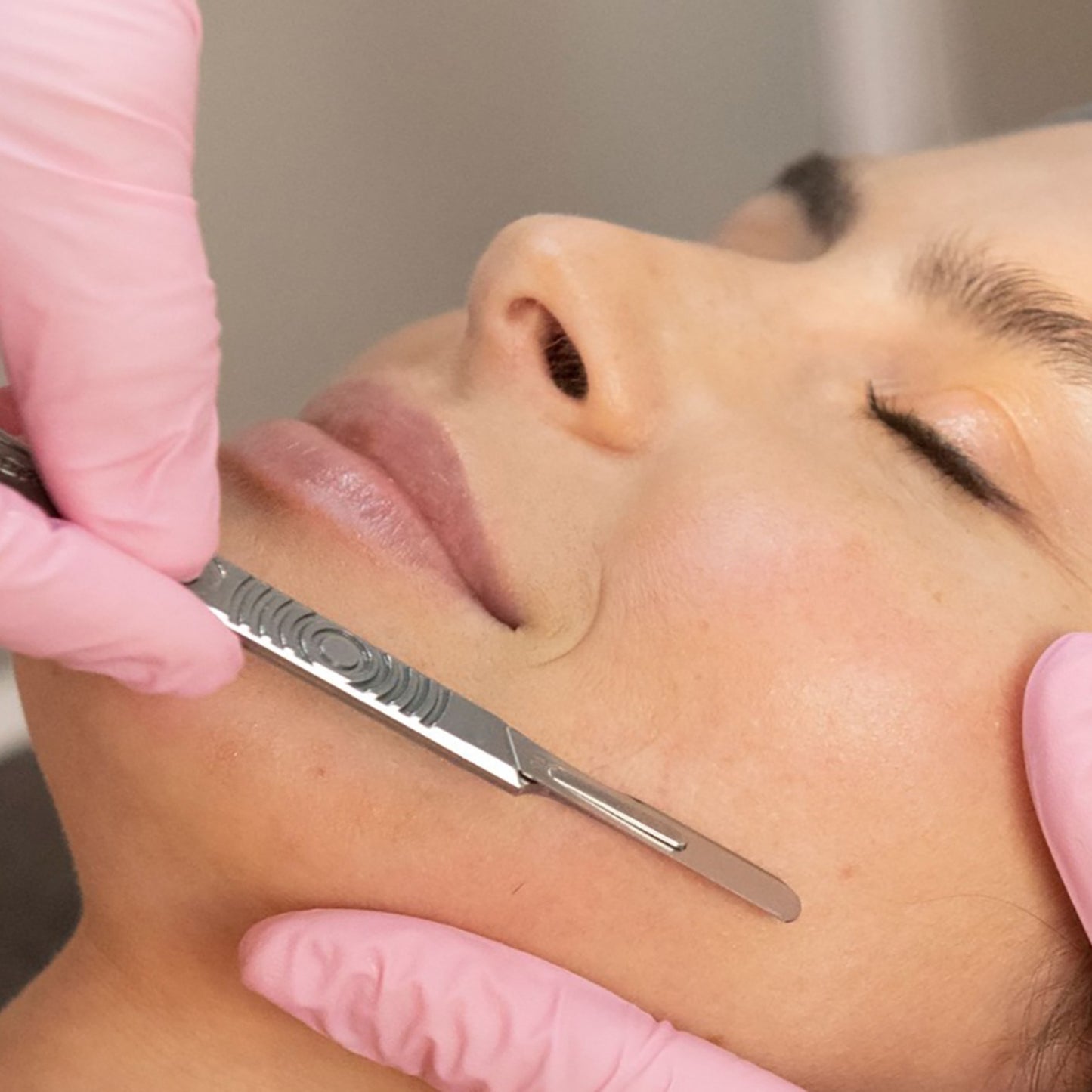 Dermaplaning